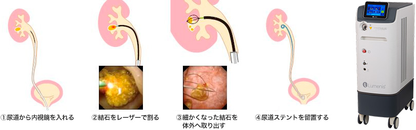 経尿道的尿管砕石術(TUL)
