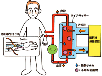 人工透析イメージ